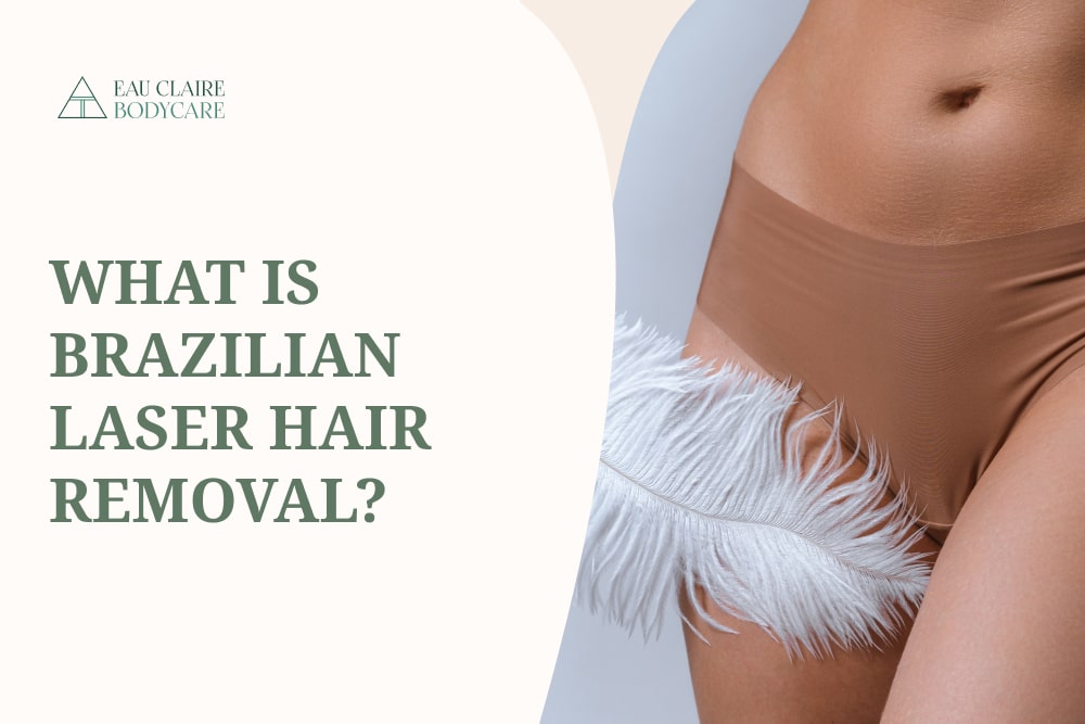What is Brazilian Laser Hair Removal?